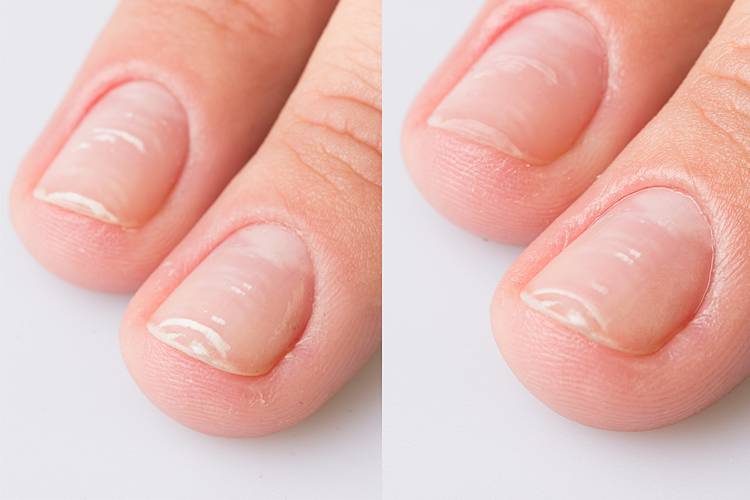 Как восстановить обгрызенные ногти: простые способы + 5 народных способов восстановления