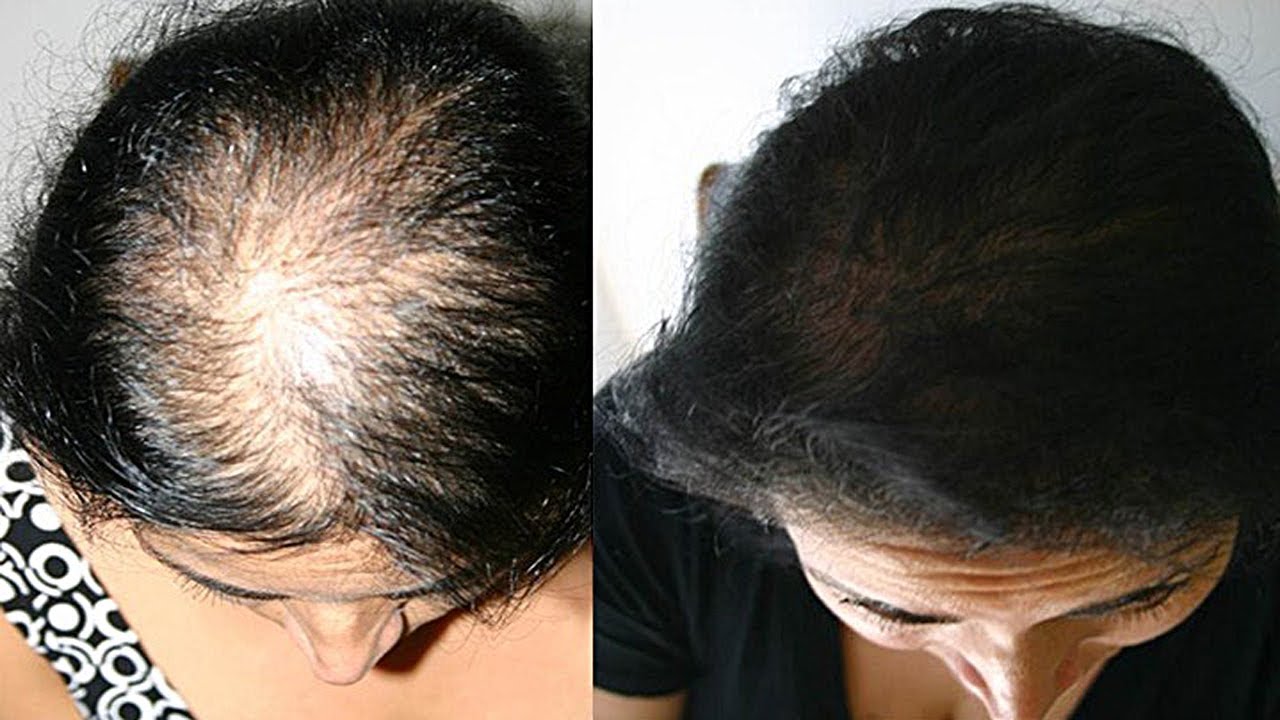 Андрогенетическая алопеция. выпадение волос - медицинский центр «эхинацея»