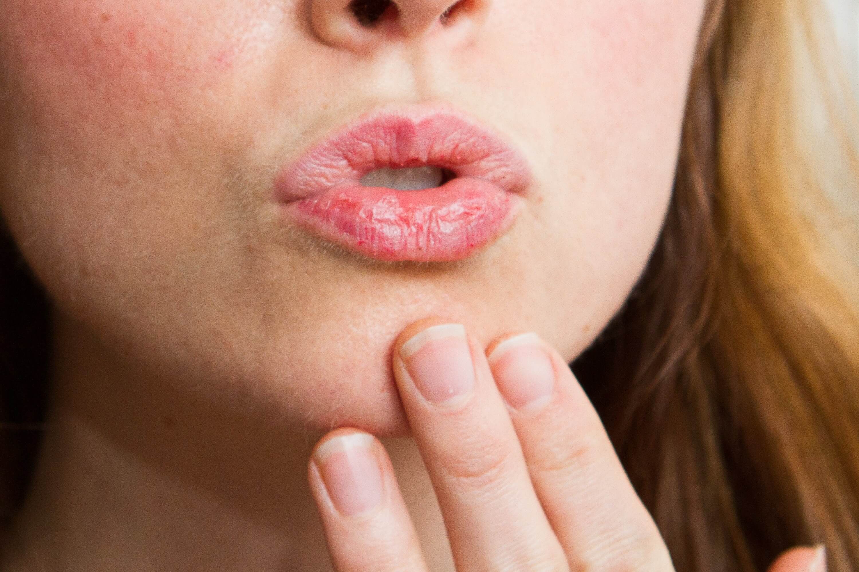 Если кожа на лице шелушится, что делать? причины шелушения и способы его устранения – эл клиника
