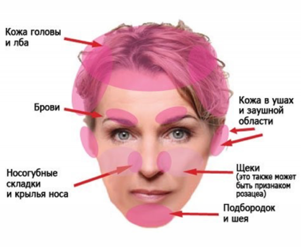 Себорея - причины, виды, симптомы, диагностика и лечение