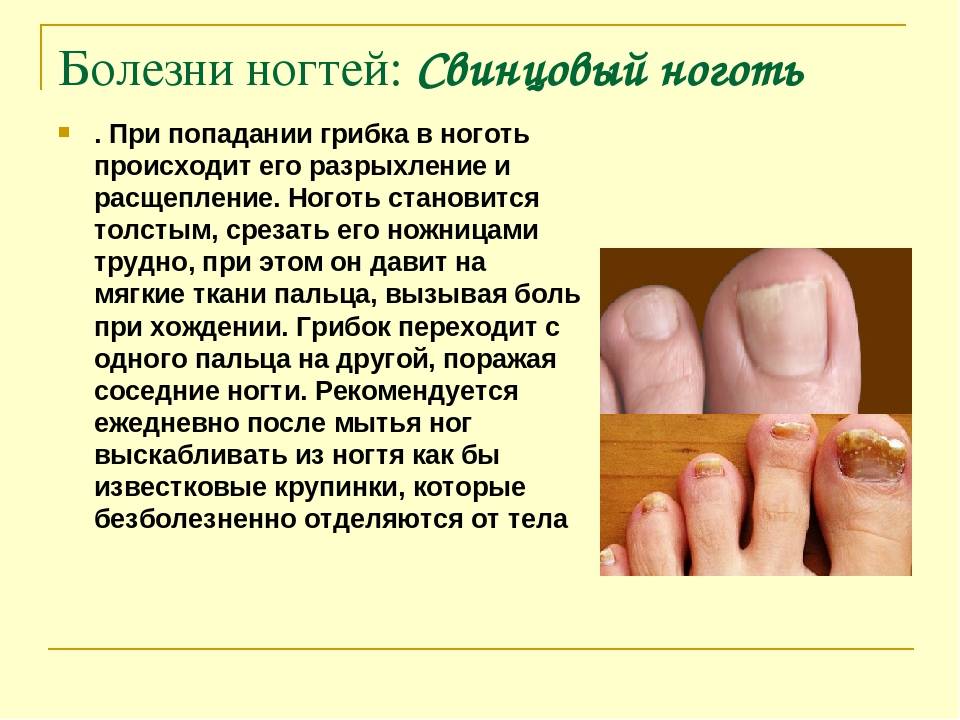 Онихомикоз (грибковая инфекция ногтей)