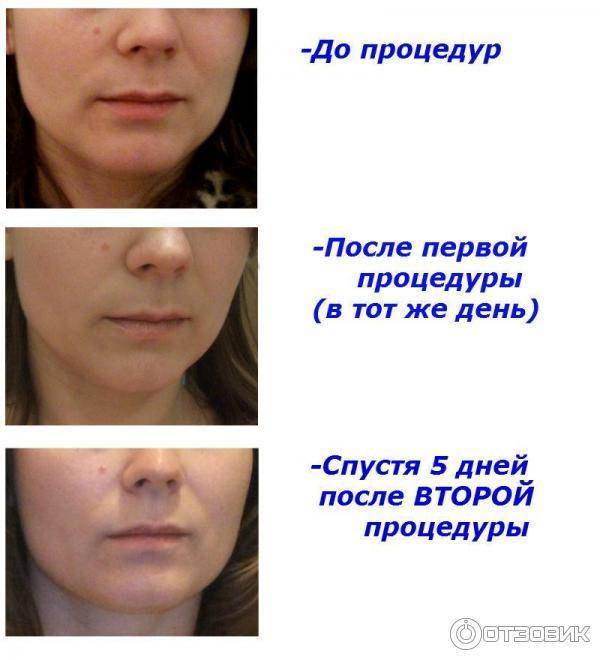 Rf лифтинг лица что это за процедура| эффект от рф лифтинга лица и тела