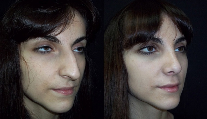 Длинный нос у девушки: что делать, фото до и после операций