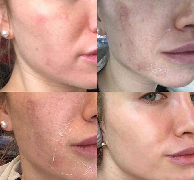 Пилинг гликолевой кислотой — центр эстетической медицины