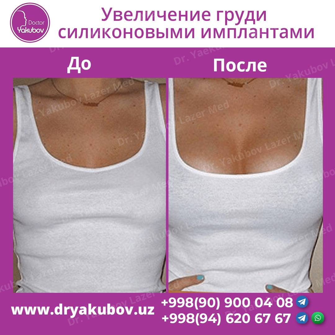 Увеличение груди с помощью современных имплантов