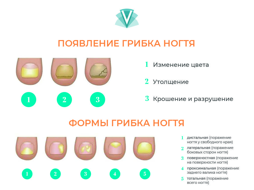 Лечение грибка ногтей. как будут выглядеть ногти после процедуры?