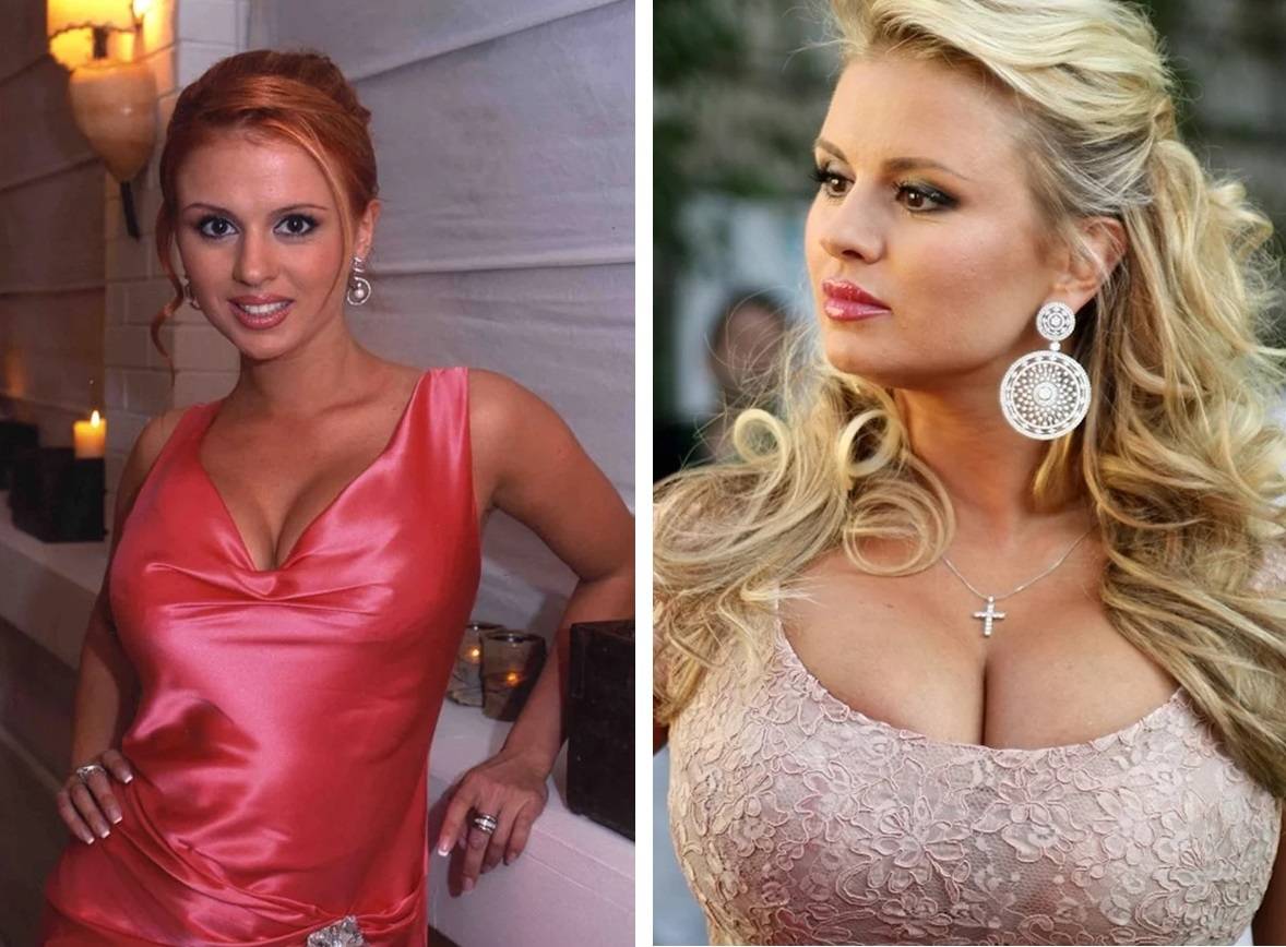 Как изменились лица российских звёзд до и после пластических операций