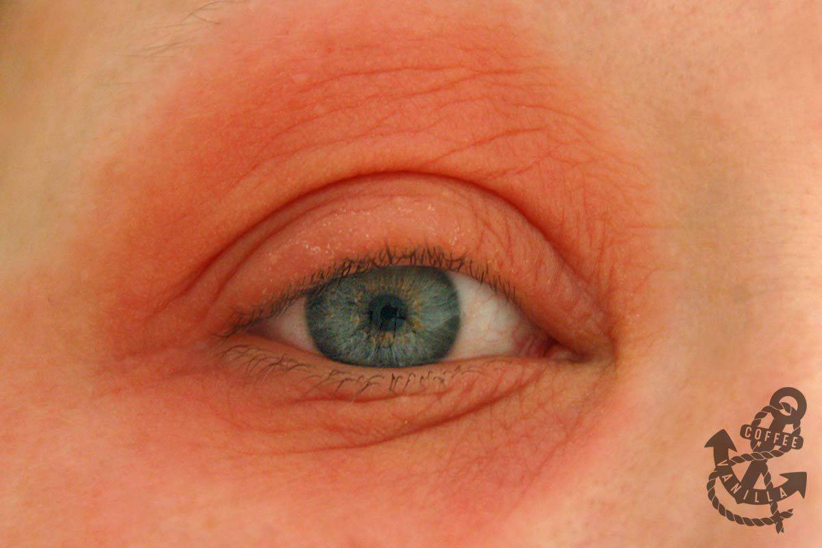 Покраснение глаза у ребенка причины и лечение фото