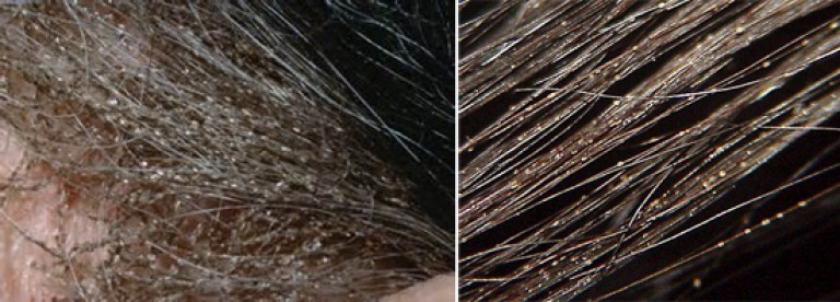 Как отличить мертвых гнид от живых, все способы убрать их с волос