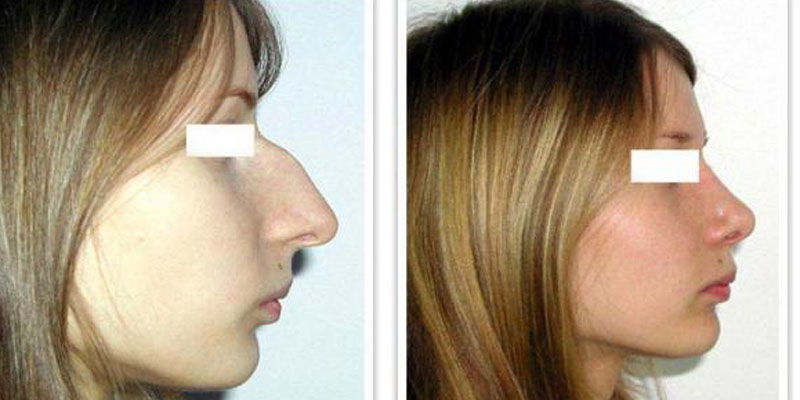 Пластическая операция со скольки лет. Бульбообразный нос ринопластика. Клювовидный нос ринопластика. Пластика кончика носа. Ринопластика до и после.