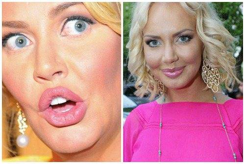 Как изменились лица российских звёзд до и после пластических операций