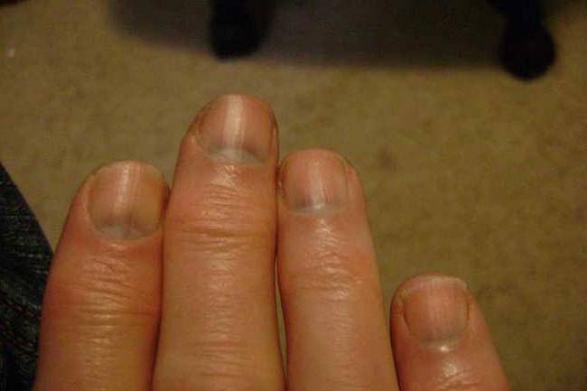 Изменение цвета ногтей: причины, симптом какой болезни | food and health