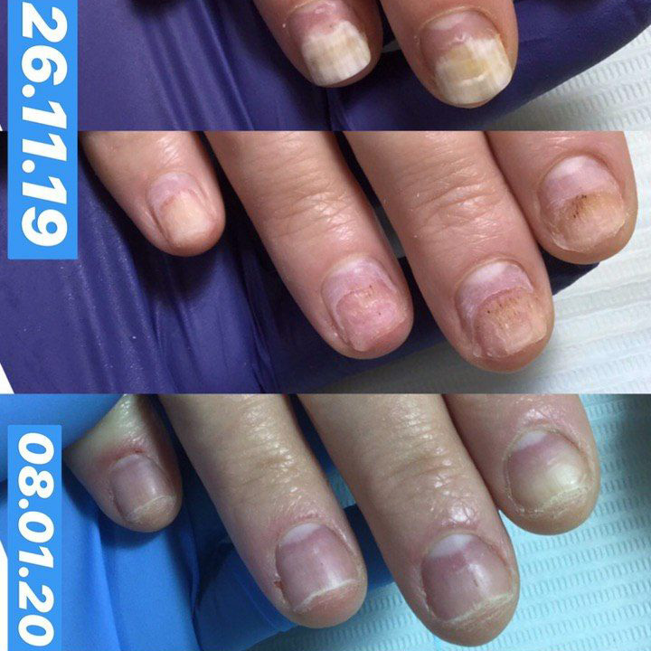 Как быстро восстановить ногти и кожу вокруг них после наращивания