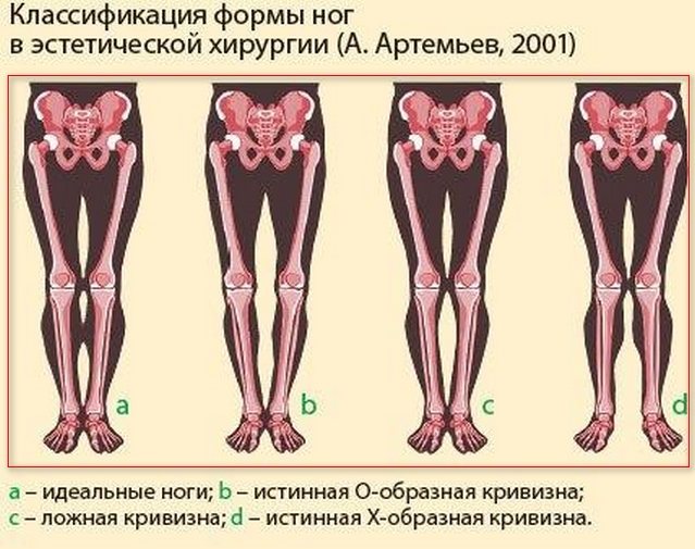 Как исправить кривые ноги упражнениями | рецепт здоровья - здоровый образ жизни