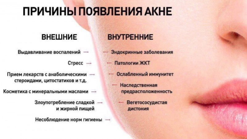 Акне у взрослых: лечение, причины, признаки (фото)