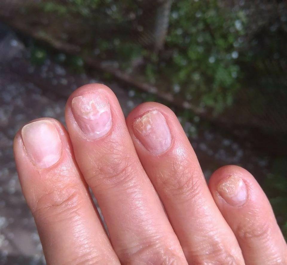 Как восстановить ногти после наращивания быстро?