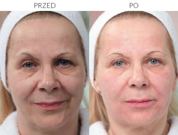 Мнение косметолога: «российские препараты для биоревитализации абсолютно конкурентноспособны» - фарммедпром