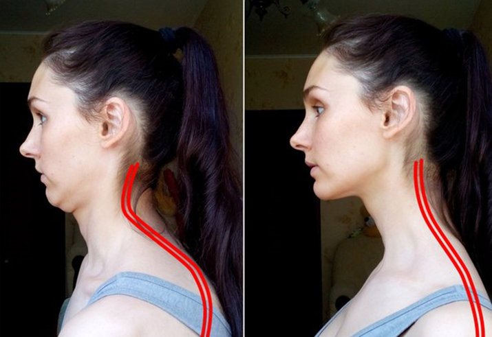 Как сделать идеальной линию челюсти? на помощь женщине придет косметология - центр эстетической медицины