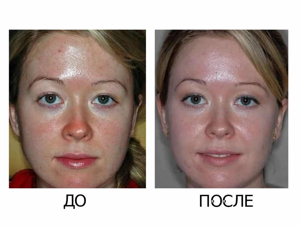 Что нужно знать о пилинге джесснера?