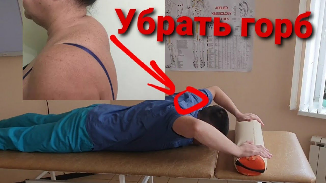 Вдовий горб: причины, симптомы, как убрать, как избавится, лечение, операция от холки на шее
