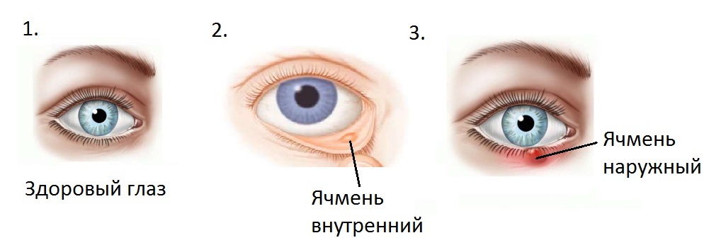 Ячмень на глазу: чем и как лечить, причины, симптомы, как выглядит (фото)