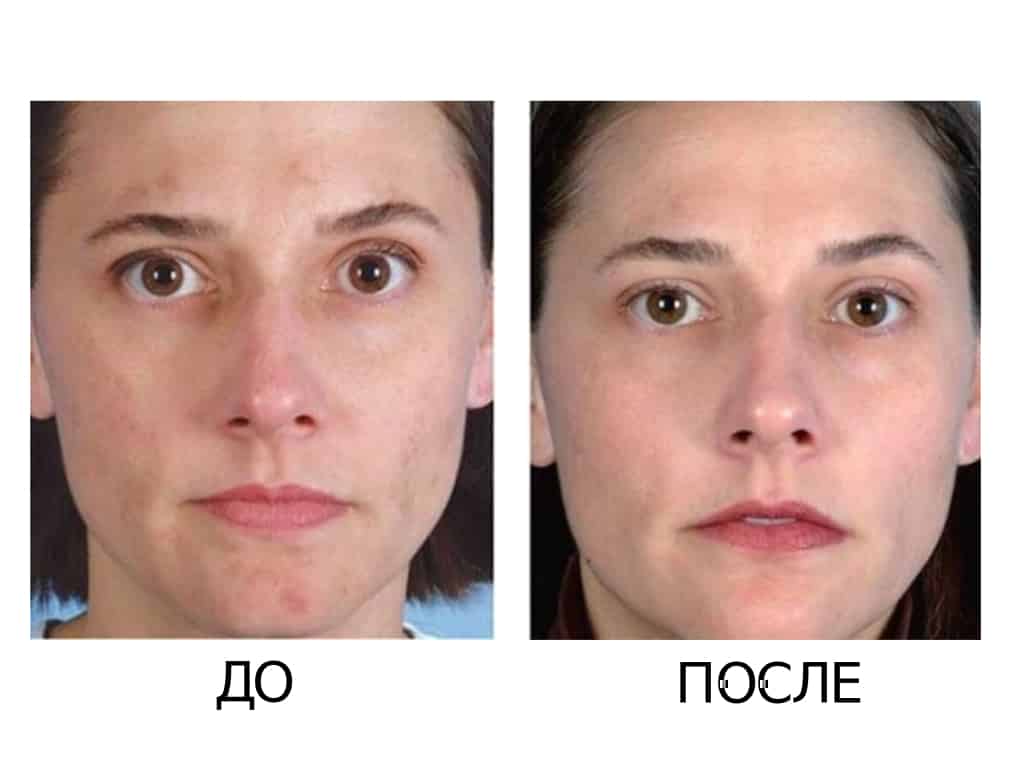 Миндальный пилинг: что это, эффективность, фото до и после, отзывы