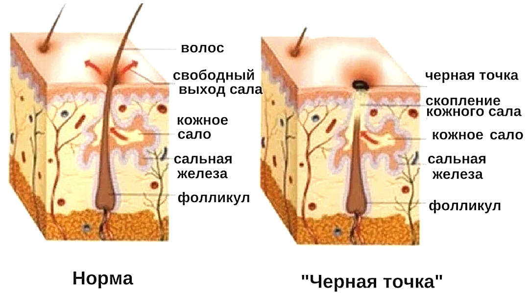 Открытые и закрытые поры. Угри, черные точки сальные нити. Черные точки комедоны или сальные железы.