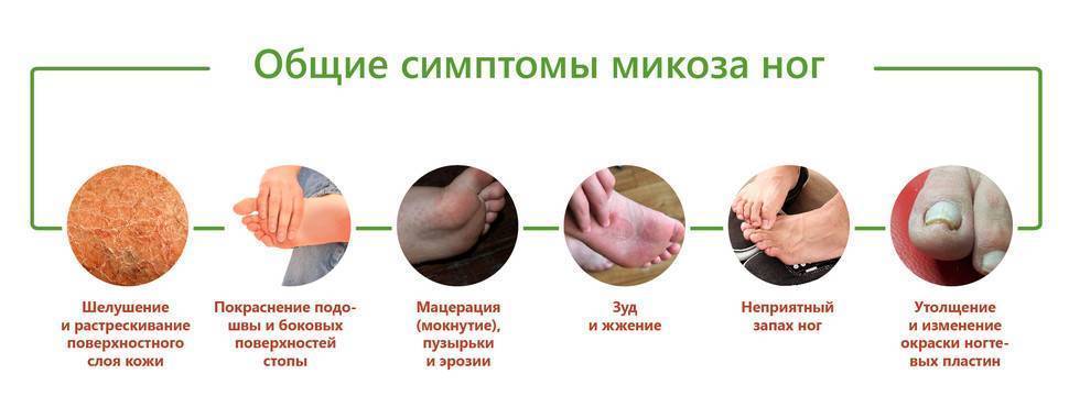 Микоз или грибок ногтей и кожи: виды, последствия отсутствия лечения