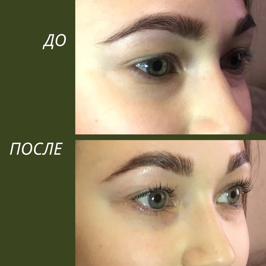Ботокс Бровей Фото До И После