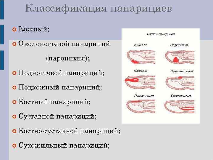 Причины, симптомы и лечение панариция. амбулаторная хирургия во владивостоке