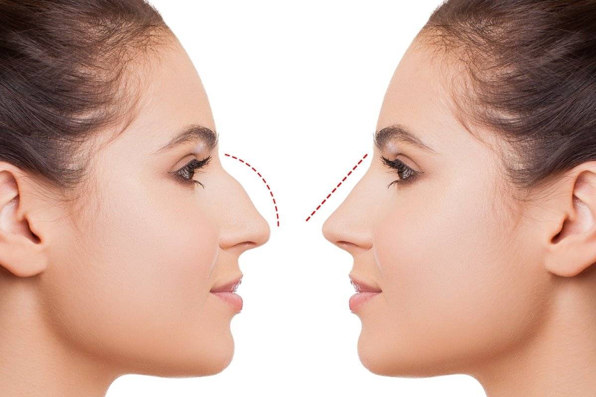 Как убрать горбинку на носу: способы коррекции без операции и с помощью пластической хирургии