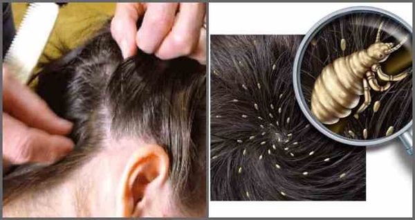 Как отличить перхоть от гнид на волосах - главные признаки и рекомендации