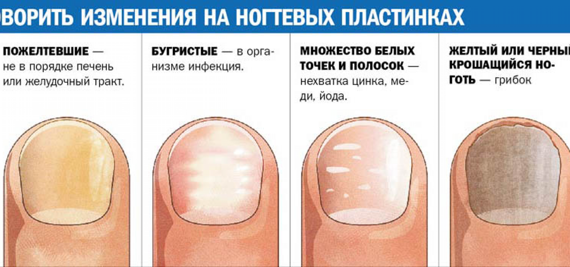 У ребенка слоятся ногти на руках: возможные причины, симптомы, лечение