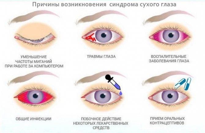 Какие глазные капли снимают отек век?
