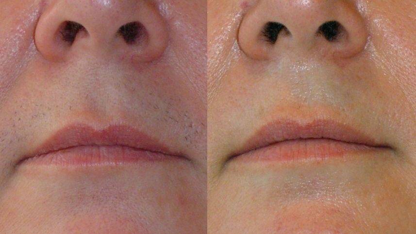 Усы и способы избавиться от усов: от эпиляции до лазера | vogue russia
