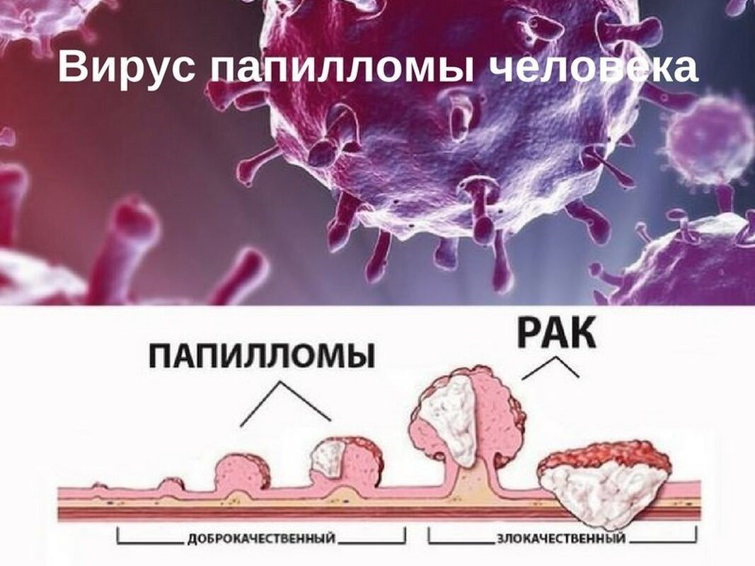 Почему появляются бородавки на лице и насколько опасны образования