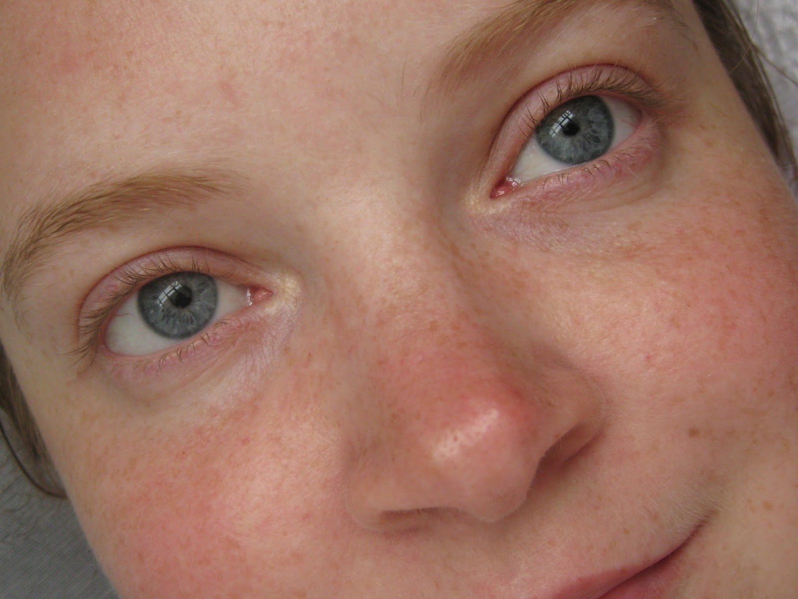 Чешутся уголки глаз - причины и лечение - офтальмологические клиники «эксимер» (киев) – диагностика и лечение заболеваний глаз у взрослых и детей