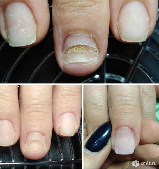 Простые правила как восстановить ногти после наращивания