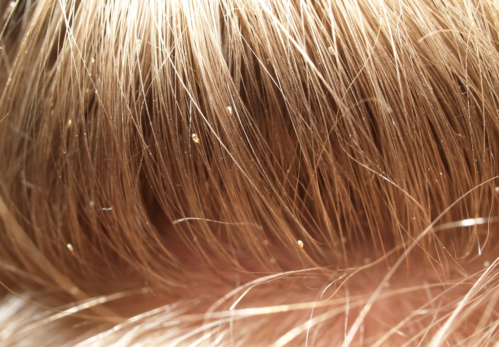Вши в волосах (педикулез): как выглядят, фото, что делать, откуда берутся на голове человека, лечение в домашних условиях