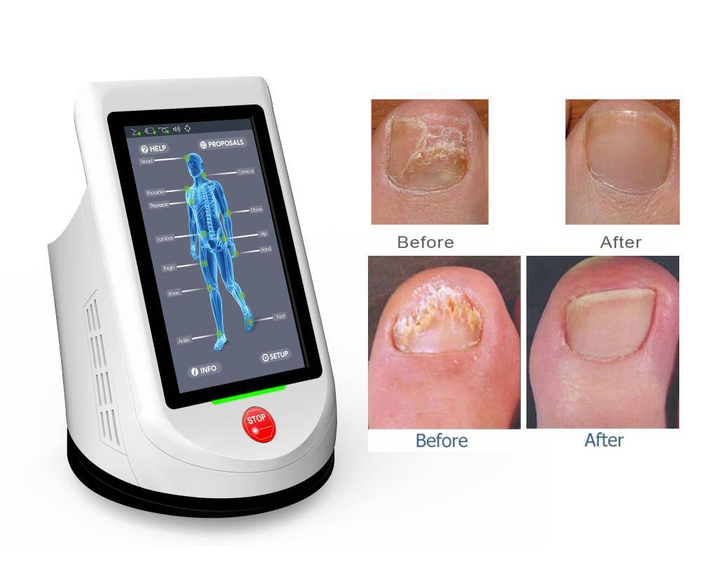 Диодный лазер 1064nm Nail fungus warts HPLT. Лазерная терапия грибка ногтей. Лазер для обработки грибка.