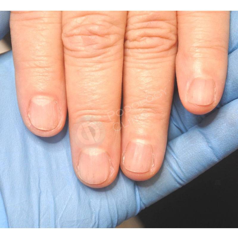 Псориаз на руках, пальцах и ногтях.: симптомы (фото), признаки, причины и лечение