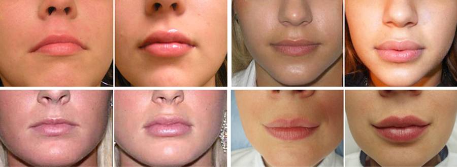 Особенности увеличения губ филлером ✔️ блог клиники лица