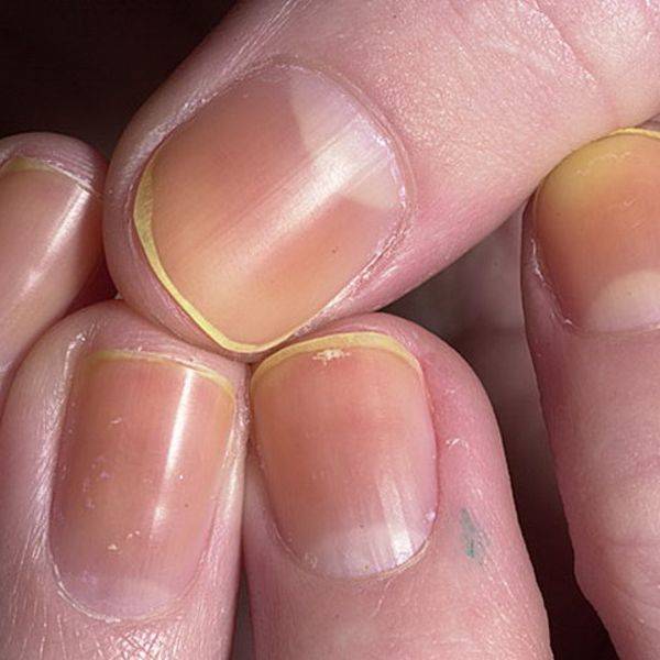 Почему желтеют ногти на руках — причины, диагностика и способы лечения, включая народные рецепты