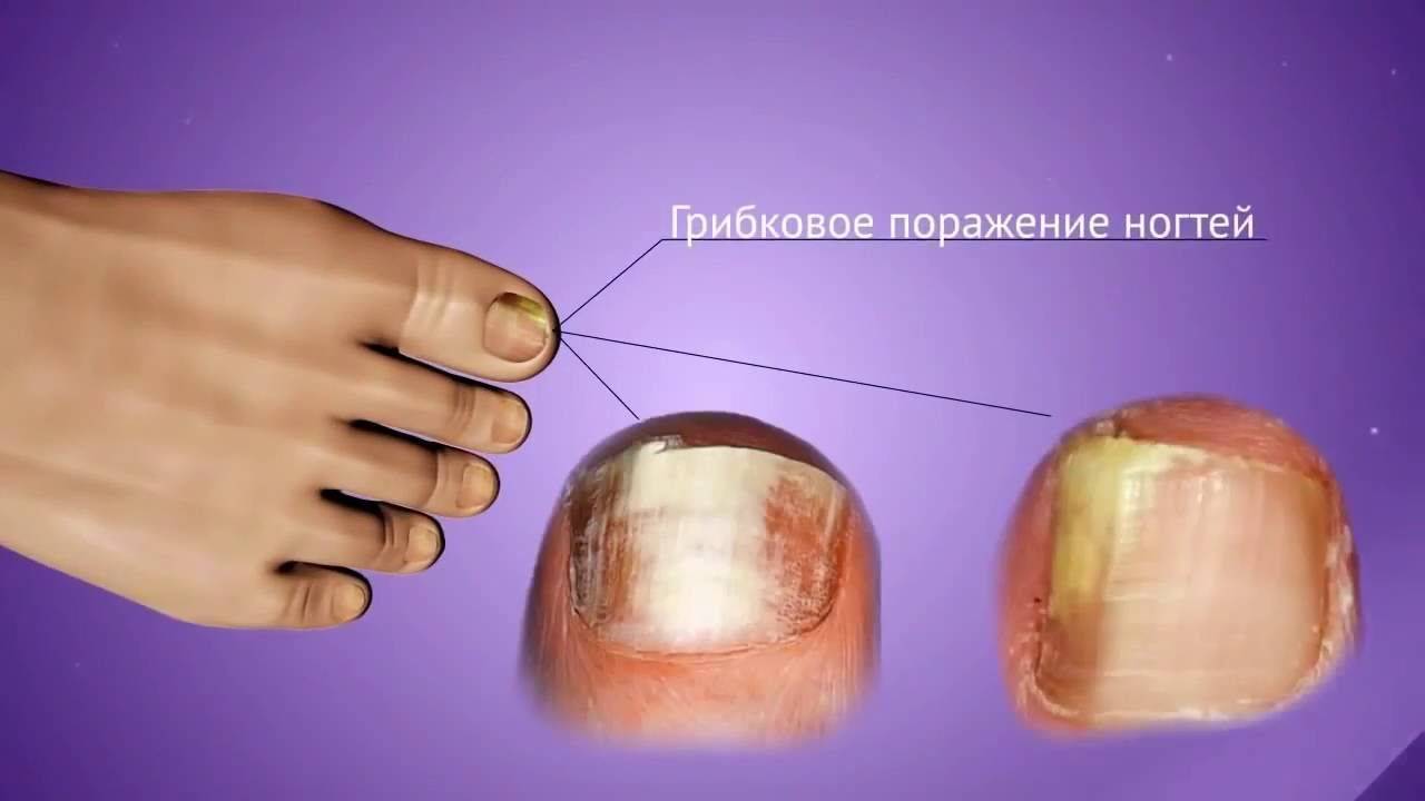 Чем опасен грибок ногтей. грибковое заболевание кожи. грибок ногтей. микоз
