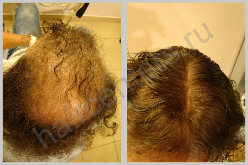 Hothair.ru - как восстановить волосы после наращивания?