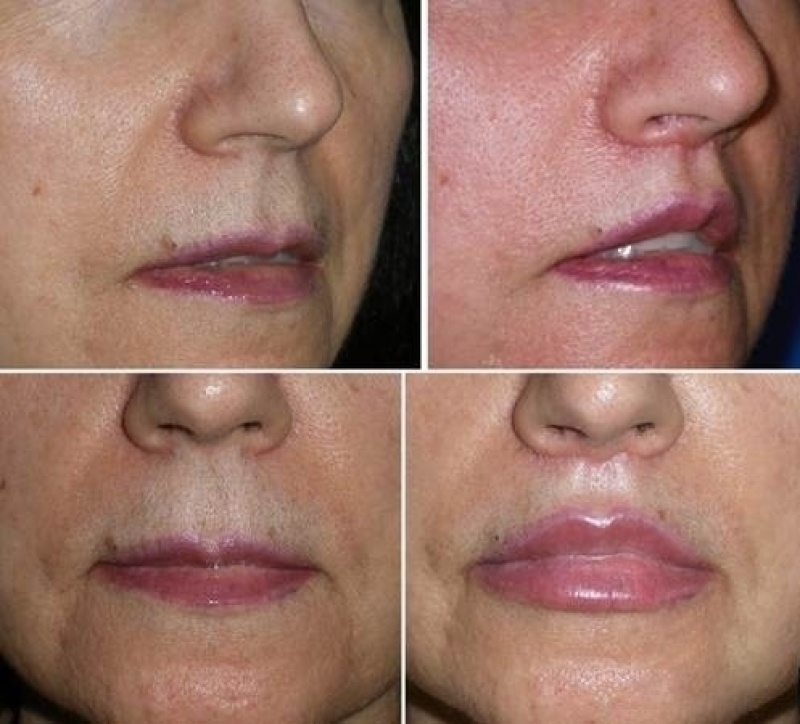 Как скорректировать большой нос: способы уменьшения носа без операции и с помощью пластической хирургии