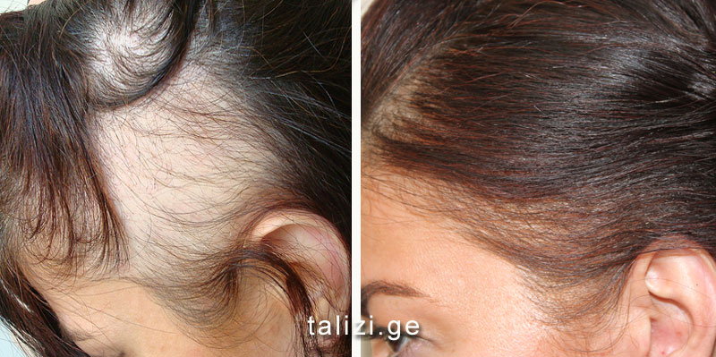 Как восстановить волосы после родов | а клиника