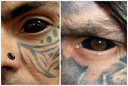 Удаление татуировки: как это делается и насколько эффективно