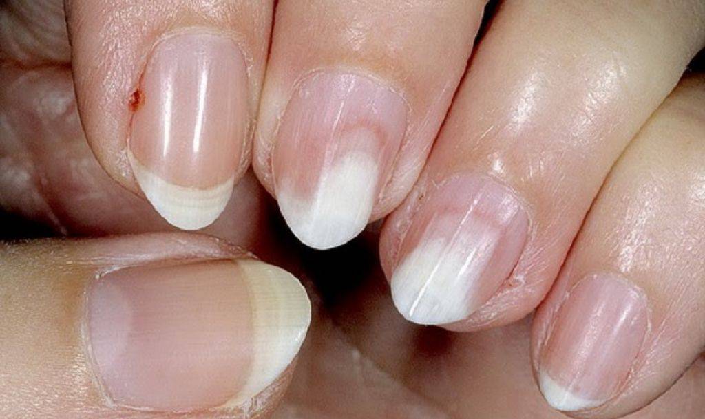 Как избежать отслойки на нарощенных ногтях? | красивые ногти - дополнение твоего образа