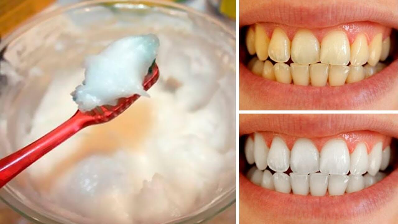 отбеливание зубов с п